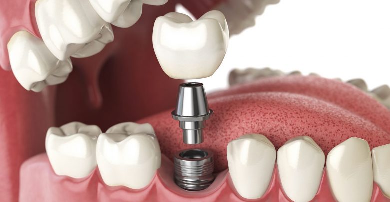 dental implant services